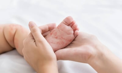 ¿Está causando el coronavirus problemas de piel en los niños?