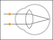 Ametropías o defectos de refracción