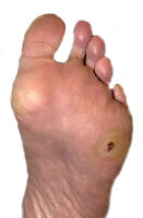 varicoza foot tromb)