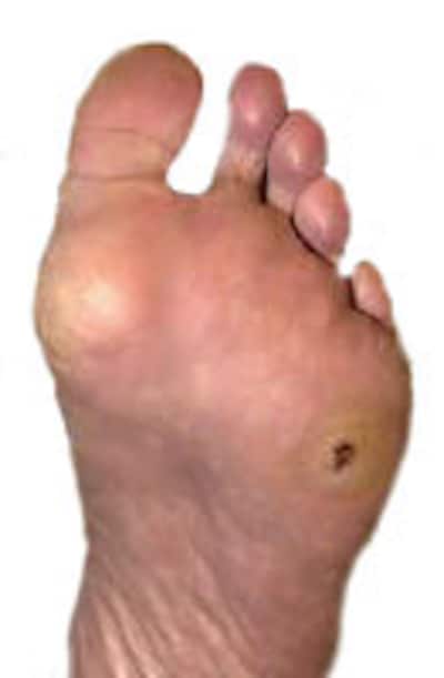 Úlceras en piernas y pies