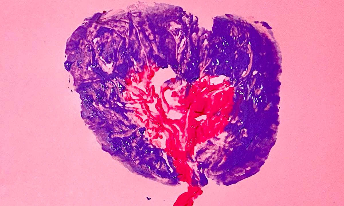 Impresión de una placenta en rojo y morado