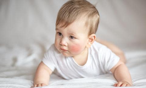 Bebé con granitos en la cara