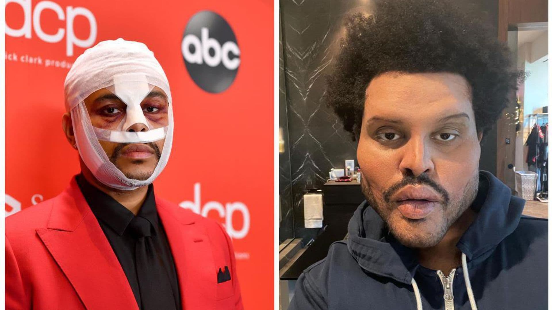 The Weeknd reveals his shocking new plastic surgery look fans call ‘Handsome Squidward’