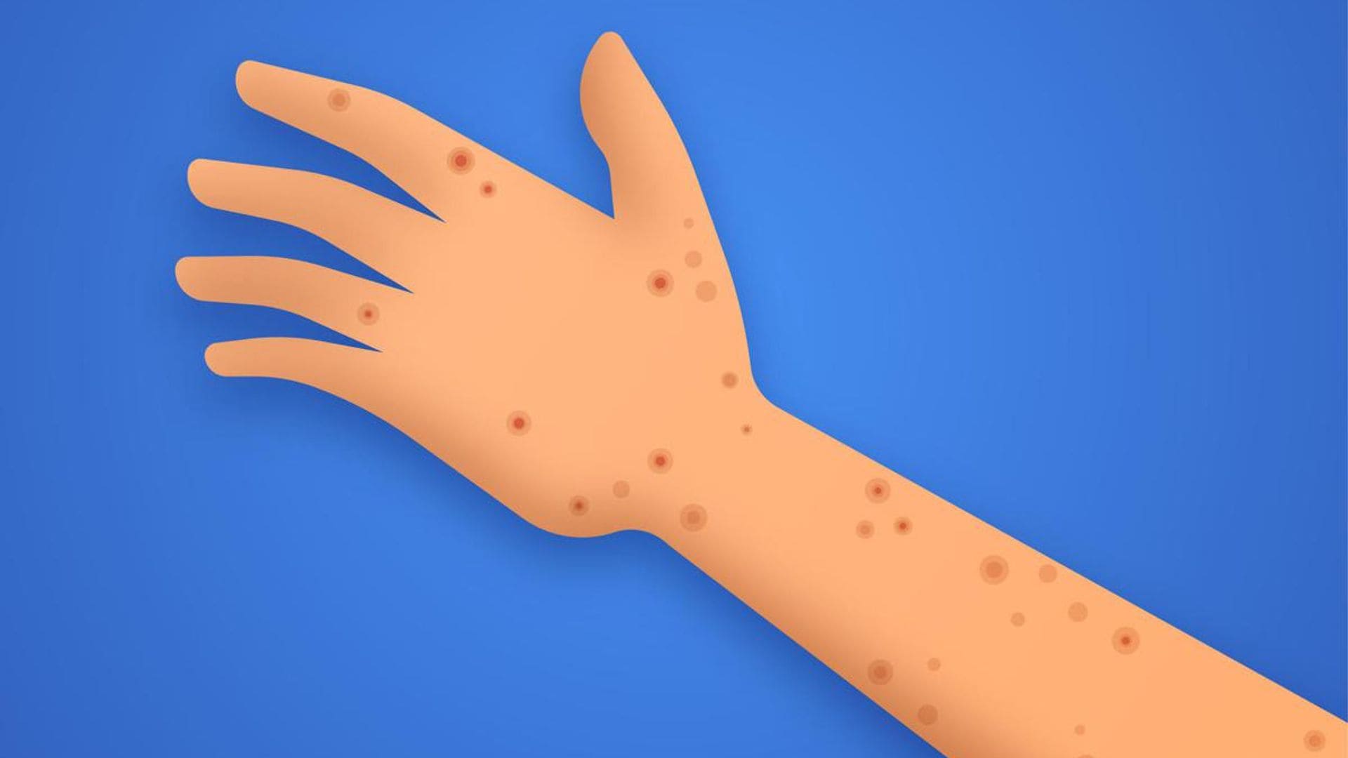 How do you take care of your skin when you have monkeypox?