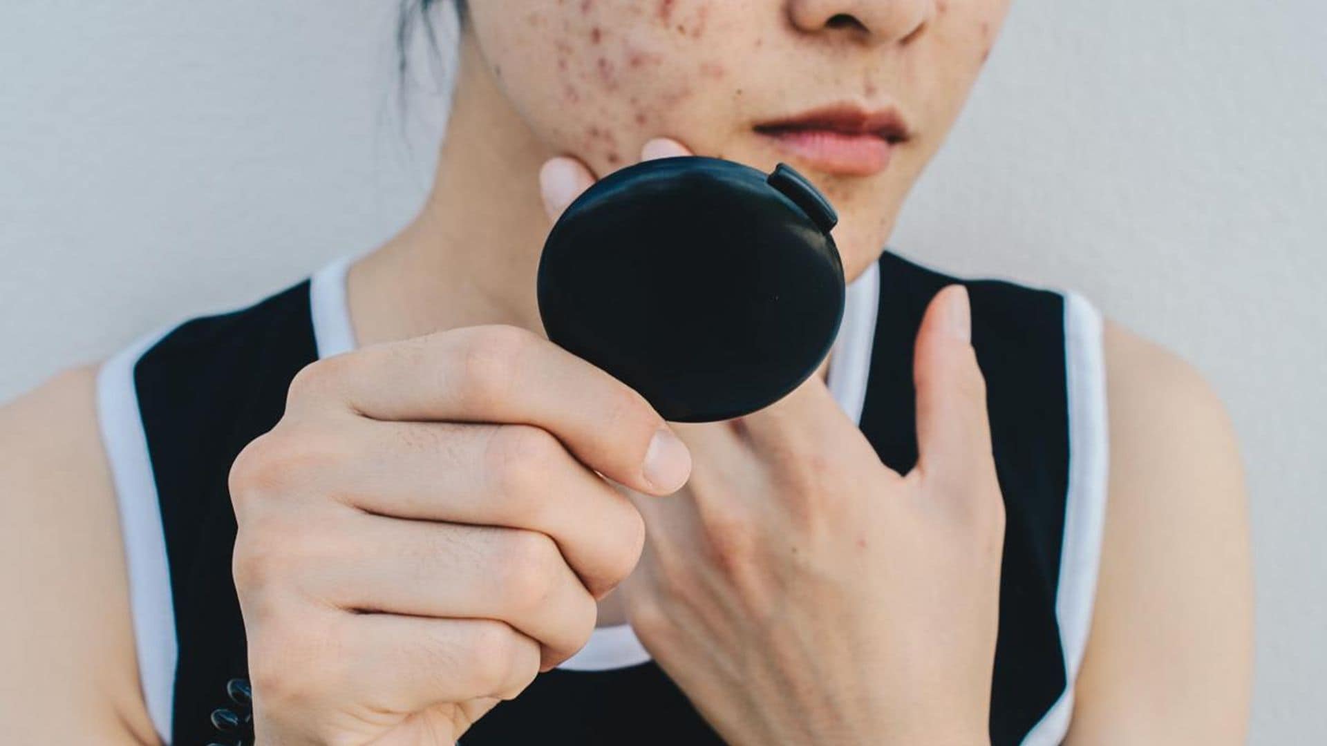 Skin expert explains what is hormonal acne and how to treat it
