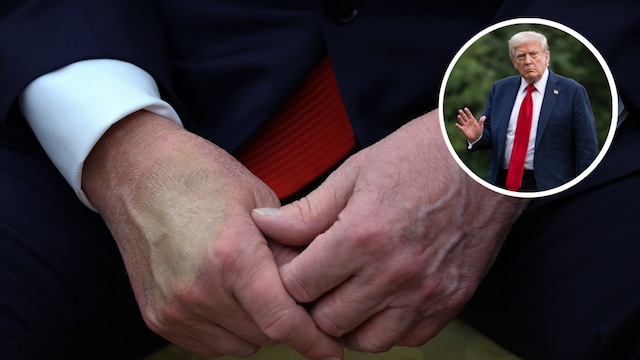 Trump's chronic vein condition explained: What is chronic venous insufficiency?