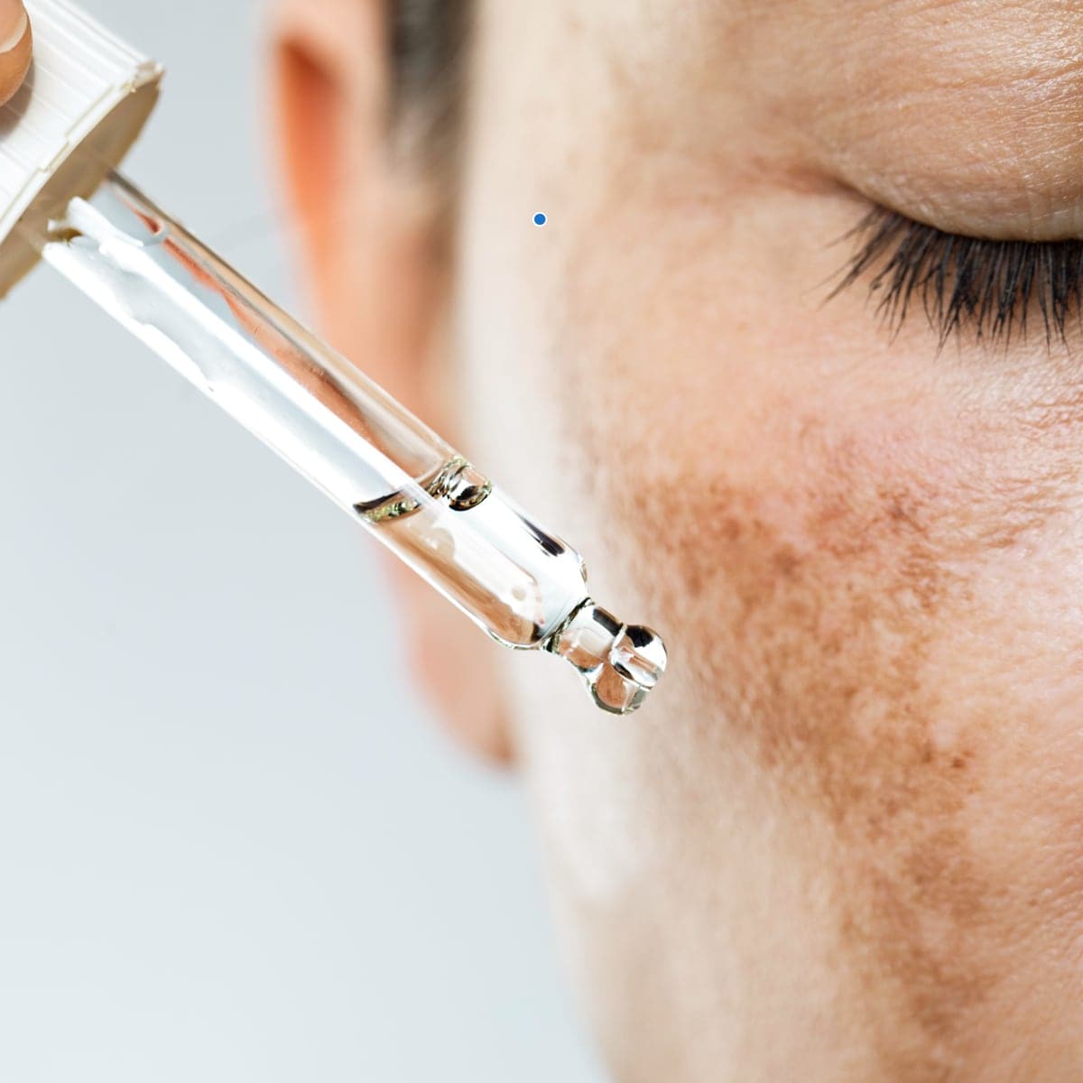 hyperpigmentation