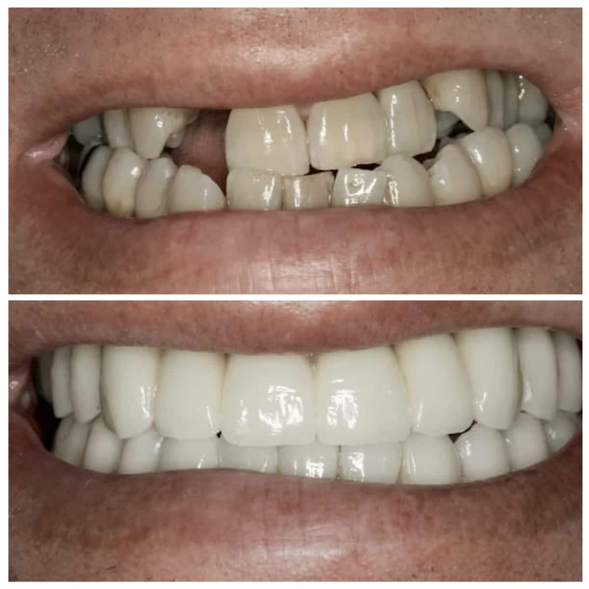 Person using veneers to fix crossbite