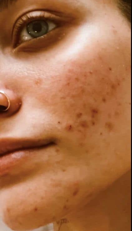 Paris Jackson found the right system for her acne 