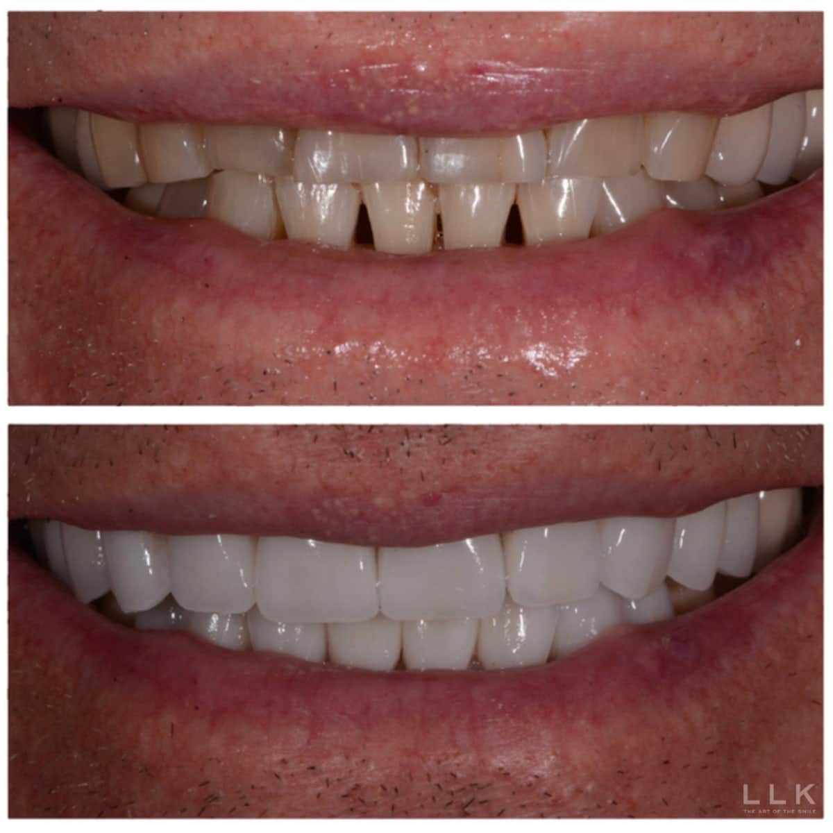 Person using veneers to fix lax jawline