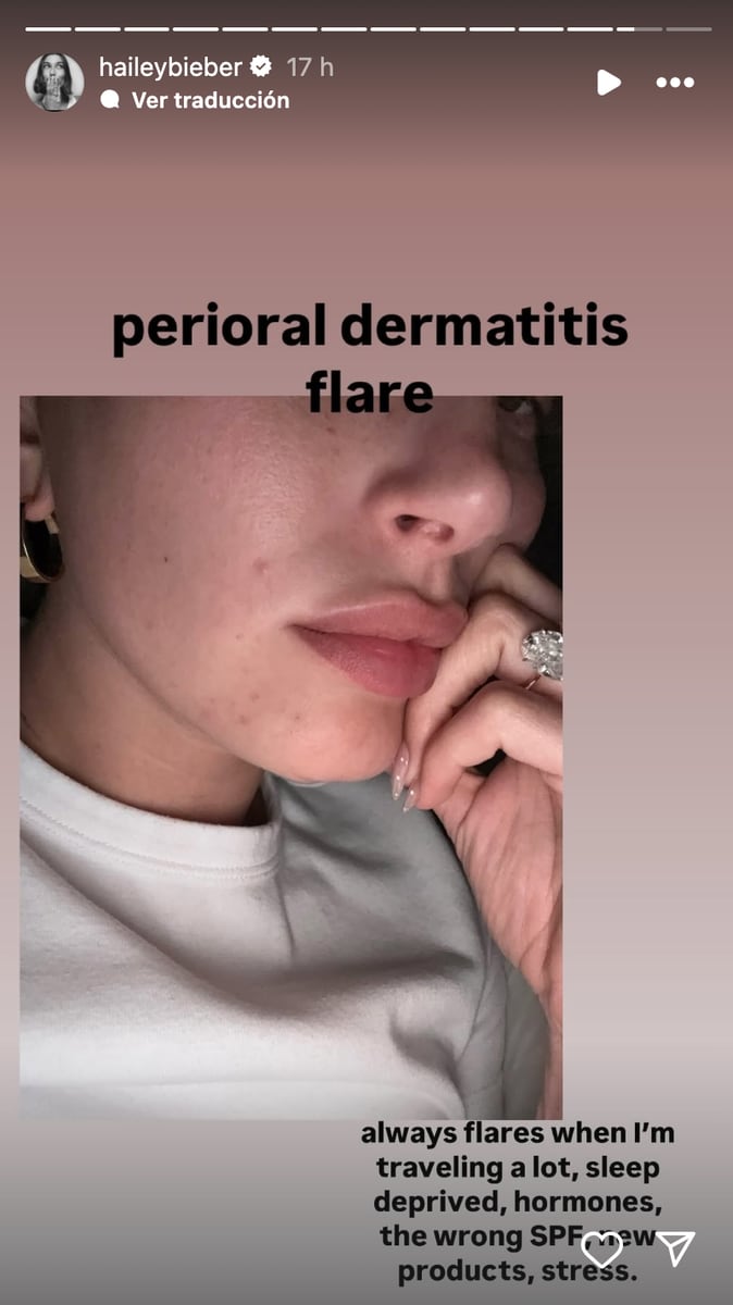 Hailey Bieber shares skin flare-up amid Justin Bieber's money drama