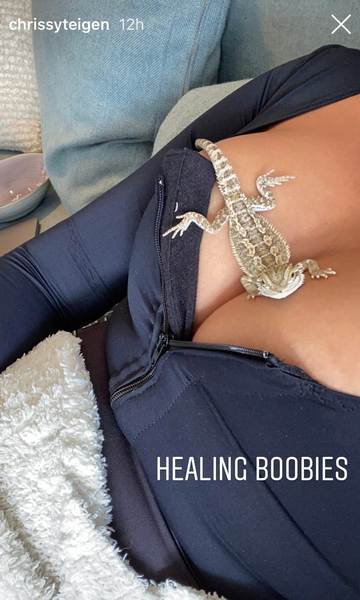 chrissy teigen surgery update