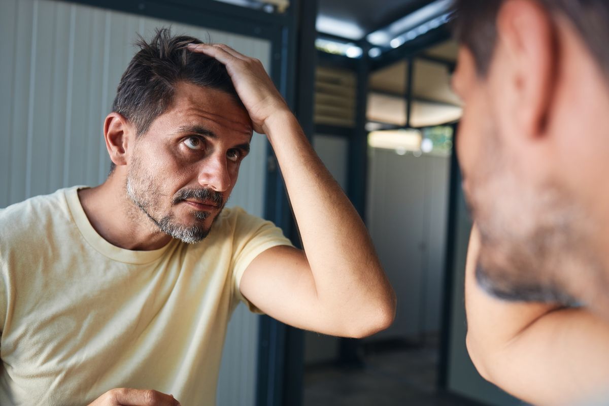 Male balding effects 30-50% of men