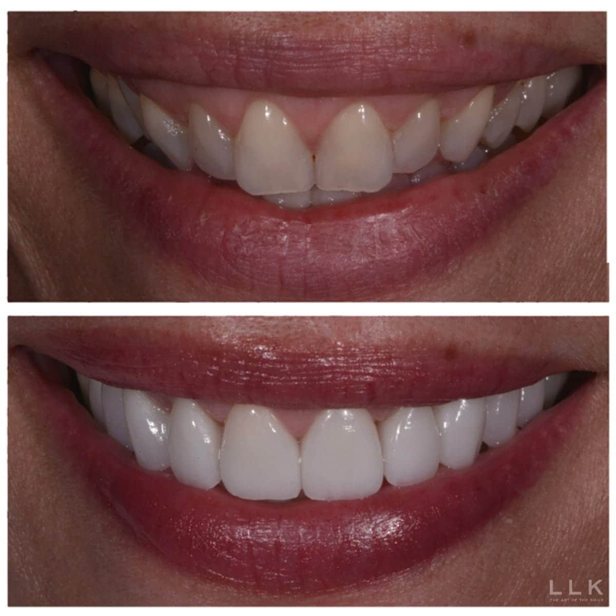 Person using veneers to fix a narrow smile