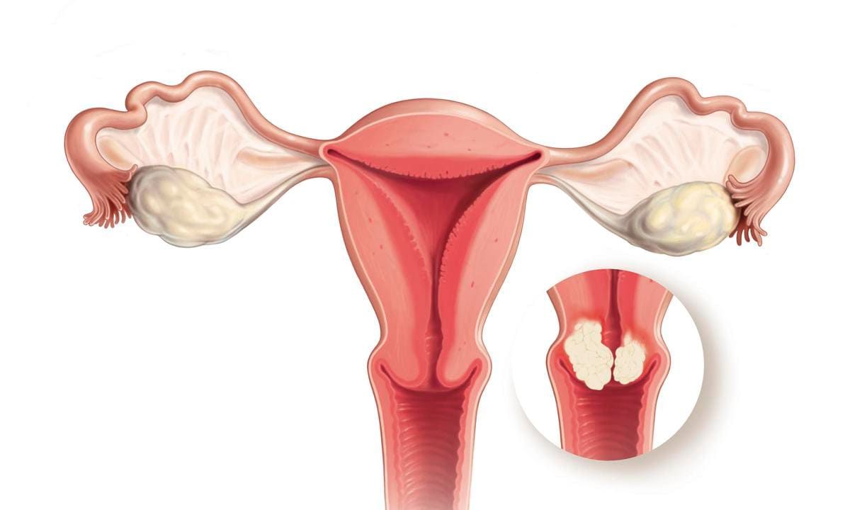 Cancer Of The Uterus, Drawing