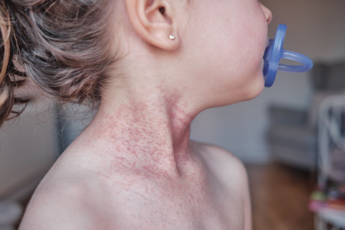 Quick treatment with antibiotics is important to prevent serious complications like sepsis.
