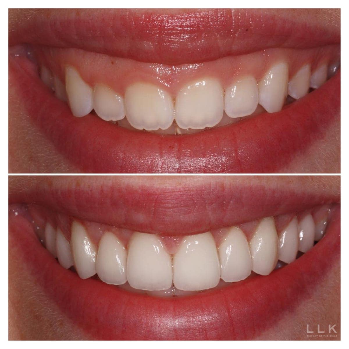 Person using veneers to fix gummy smile