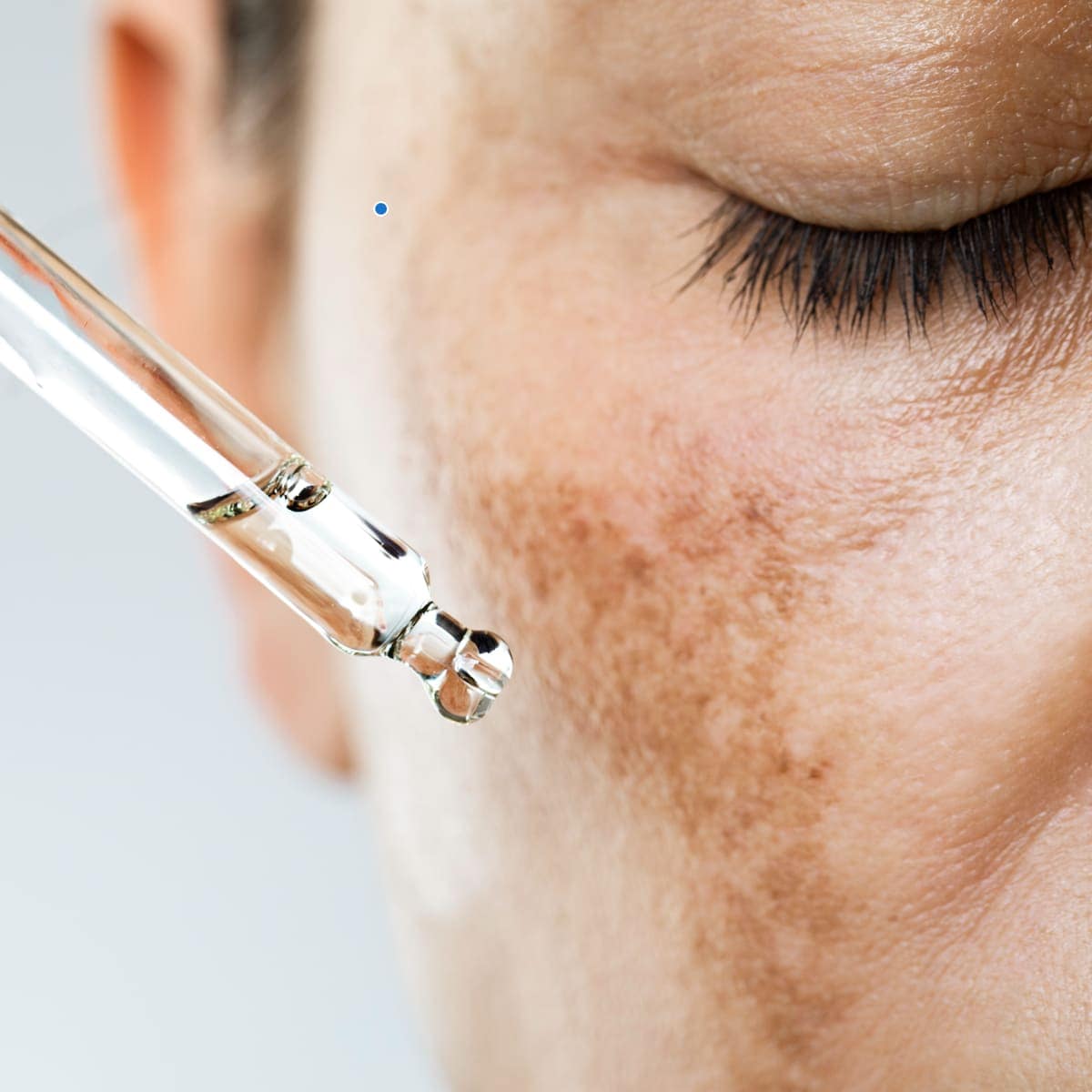 hyperpigmentation