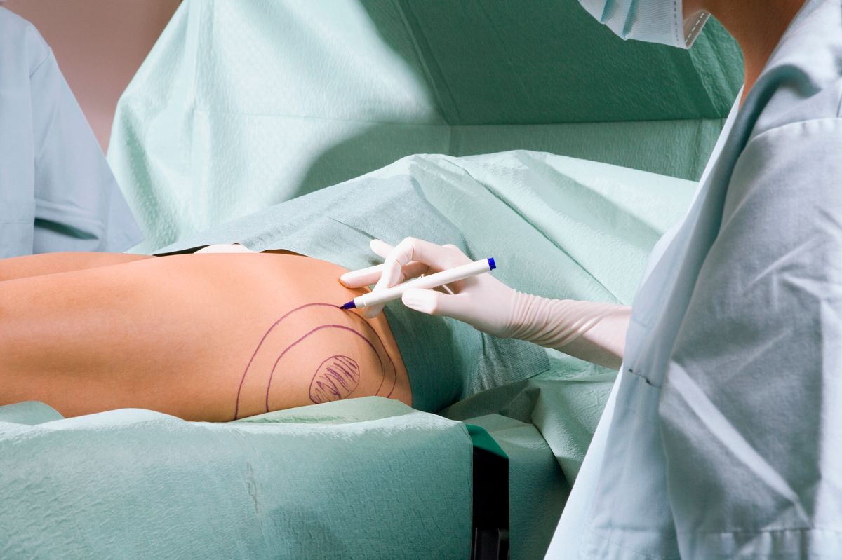 Anyone considering surgery should also investigate the surgeon’s training, the credentials and safety standards of the facility, anesthesia care, and postoperative protocols.