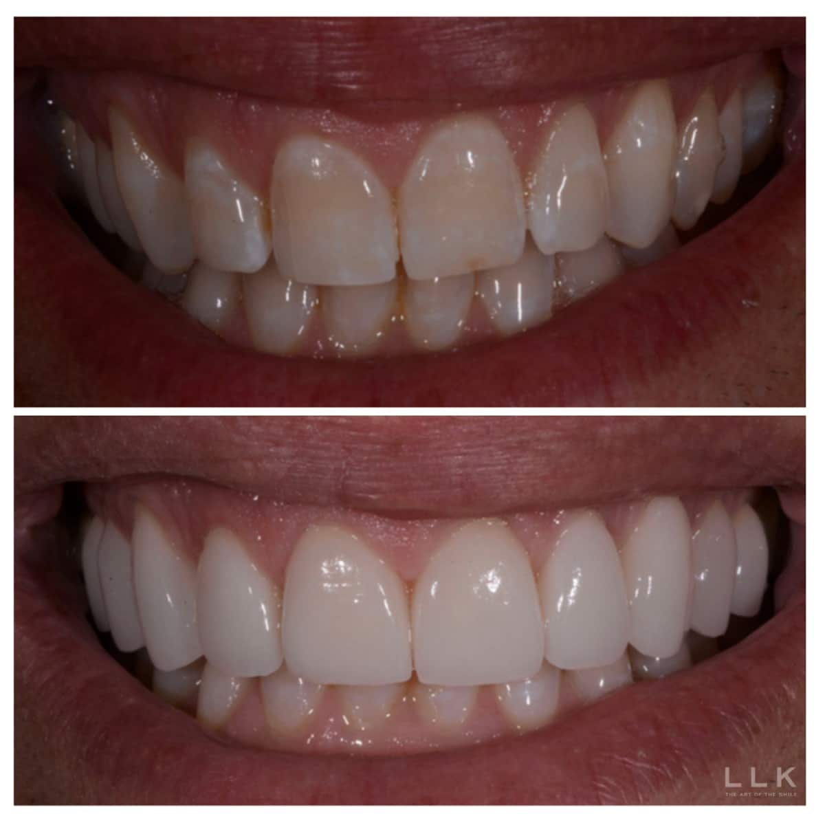 Person using veneers to fix stained teeth