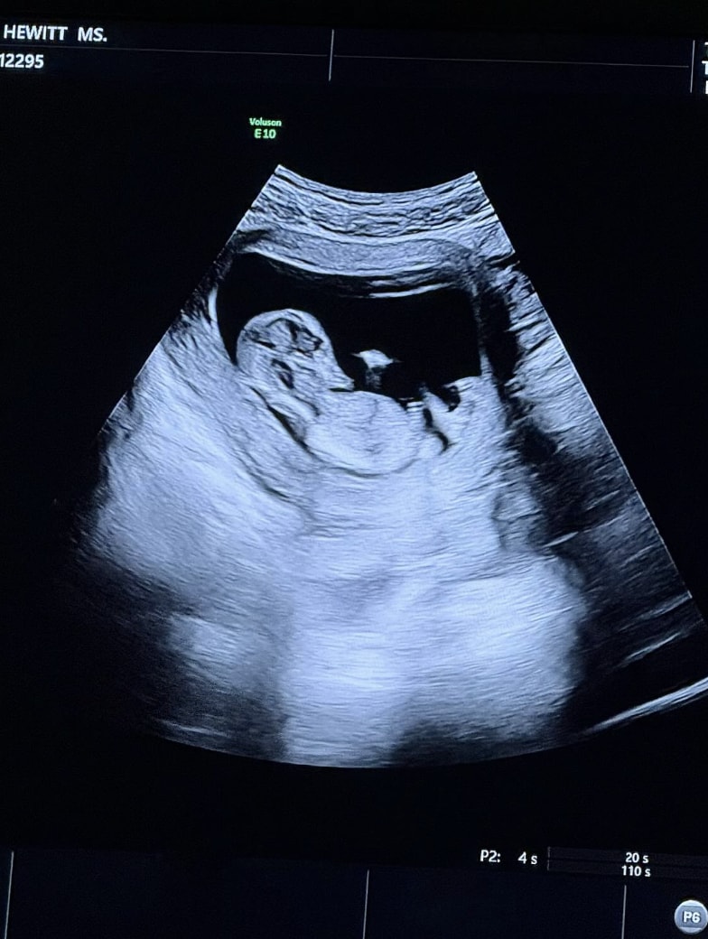 Elsie Hewitt shared a photo of her baby's first sonogram