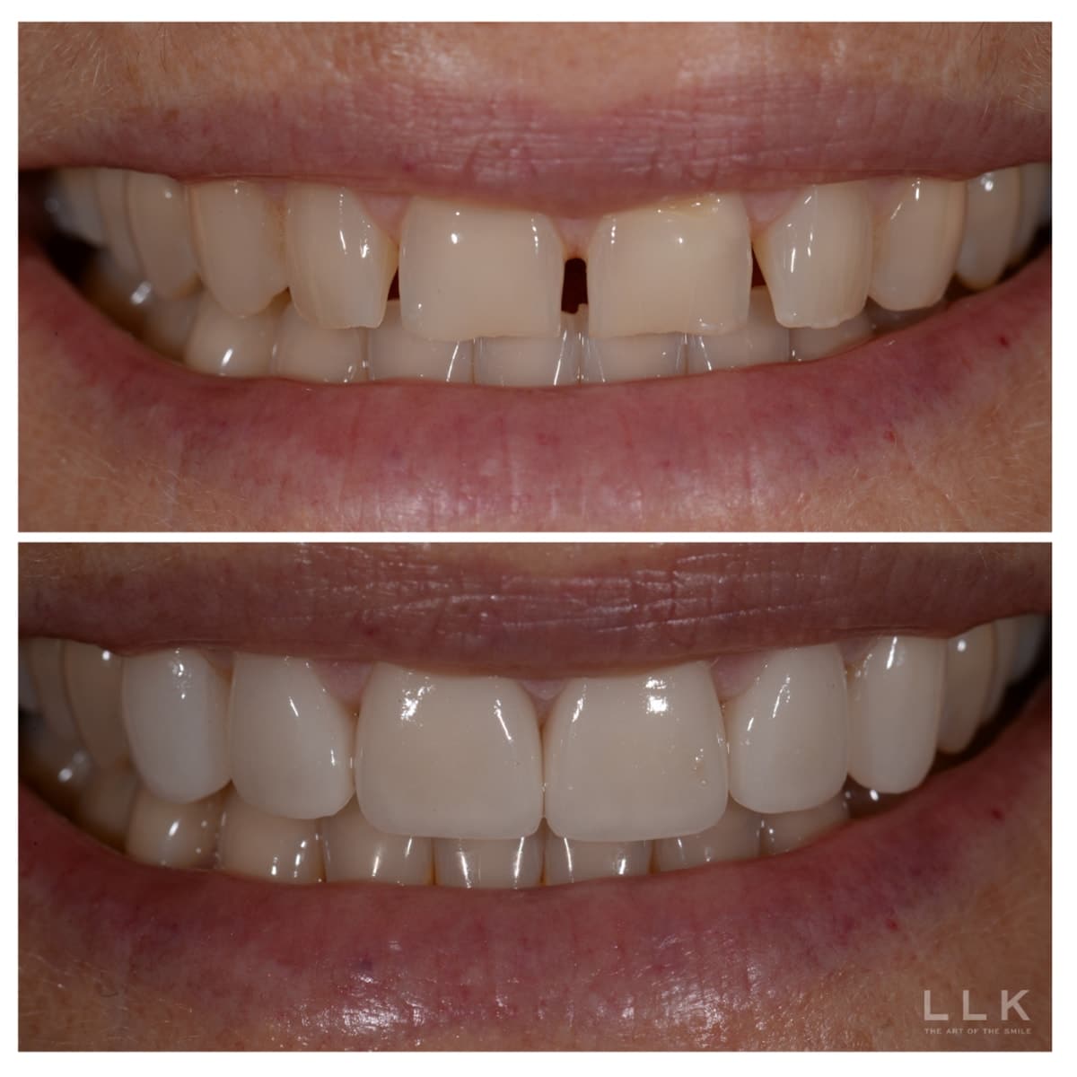Person using veneers to fix gap smile