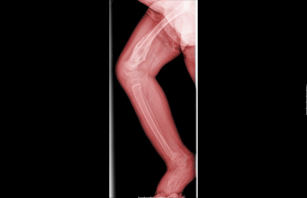 X-ray of a 3 year old infant with a heeled fracture of the Tibia and Fibula