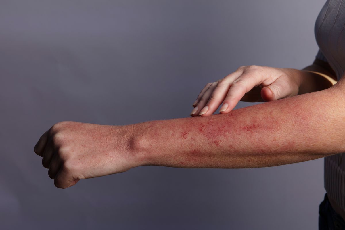 Quick treatment with antibiotics is important to prevent serious complications like sepsis.