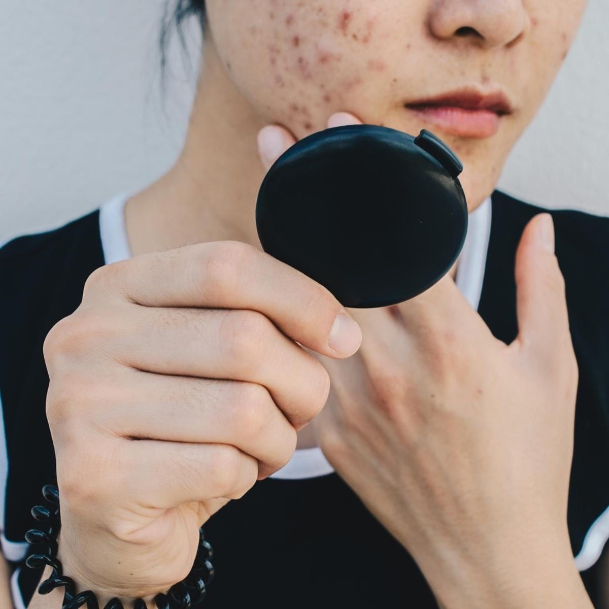 Hormonal acne