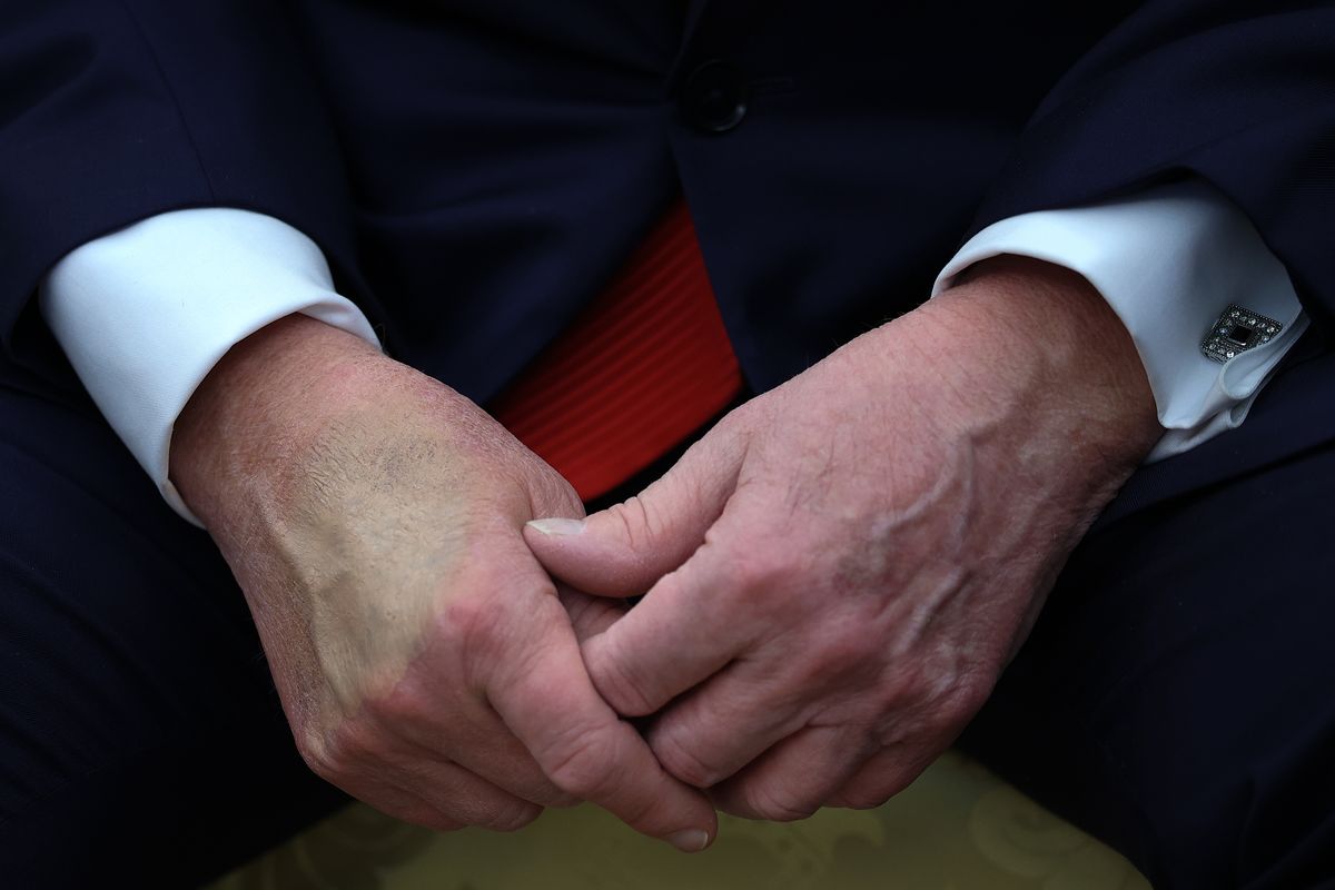 The hands of U.S. President Donald Trump are shown as he meets with President Nayib Bukele of El Salvador in the Oval Office of the White House April 14, 2025 in Washington, DC. 