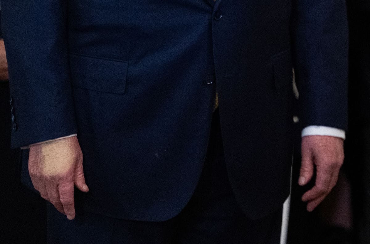  Discoloration is seen on the hand of US President Donald Trump as he attends the "Halt All Lethal Trafficking of Fentanyl Act" signing in the East Room of the White House in Washington, DC, on July 16, 2025. Trump has been diagnosed with a chronic but benign vein condition after seeking medical examination for swollen legs, the White House said on July 17, 2025.
