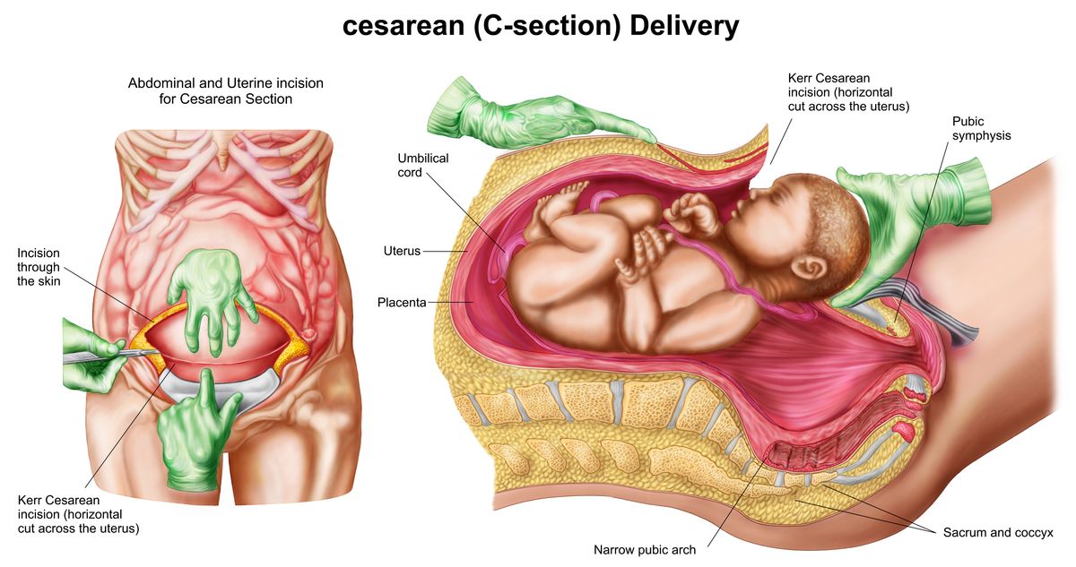 A C-section is major abdominal surgery. Surgical techniques and individual circumstances can differ.