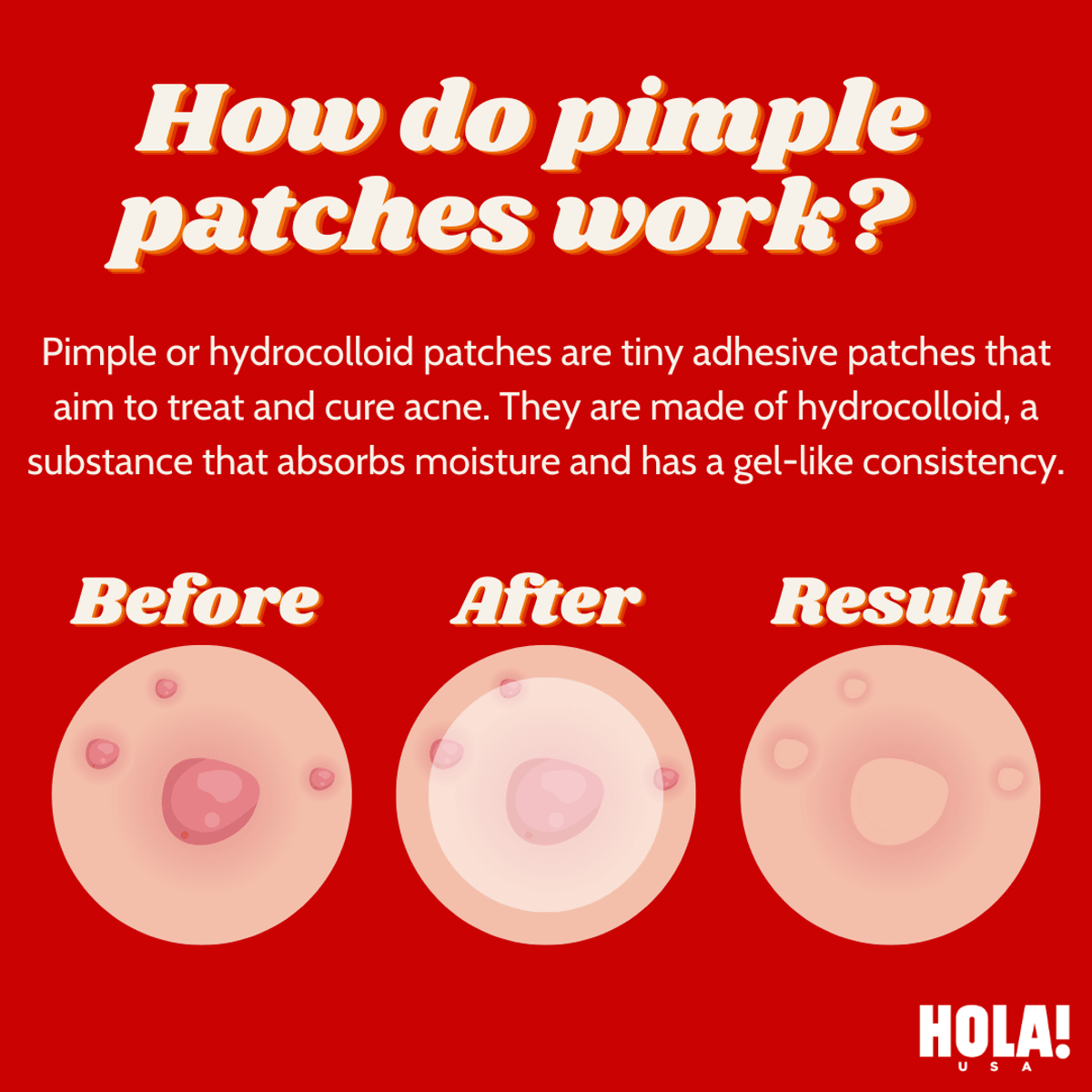 Pimple Build How do pimple patches work?