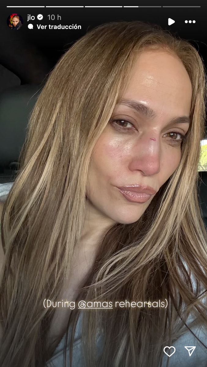 Jennifer Lopez gets stitches after bloody AMAs rehearsal
