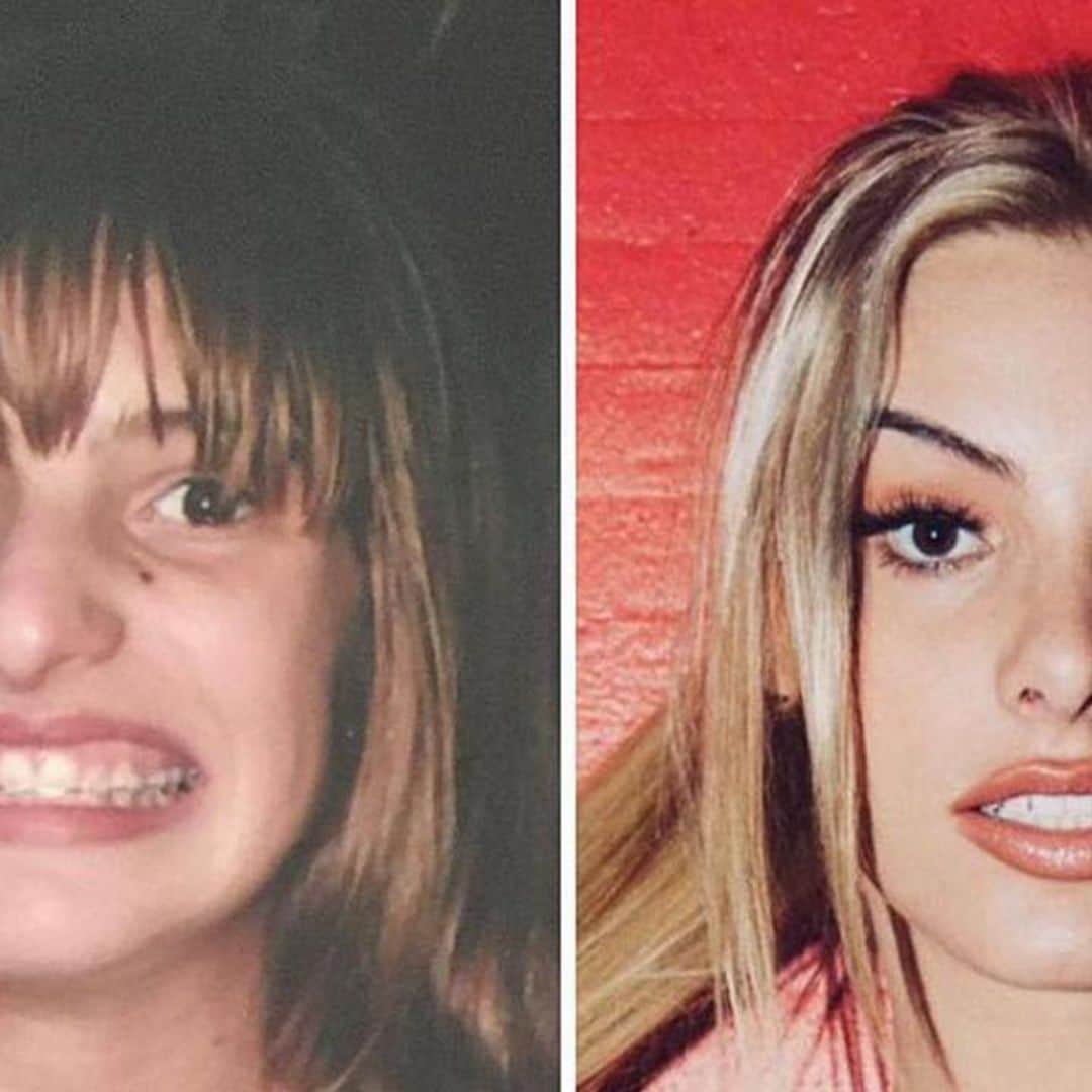 Lele Pons ‘exposes herself’ with adorable before and after rhinoplasty pics
