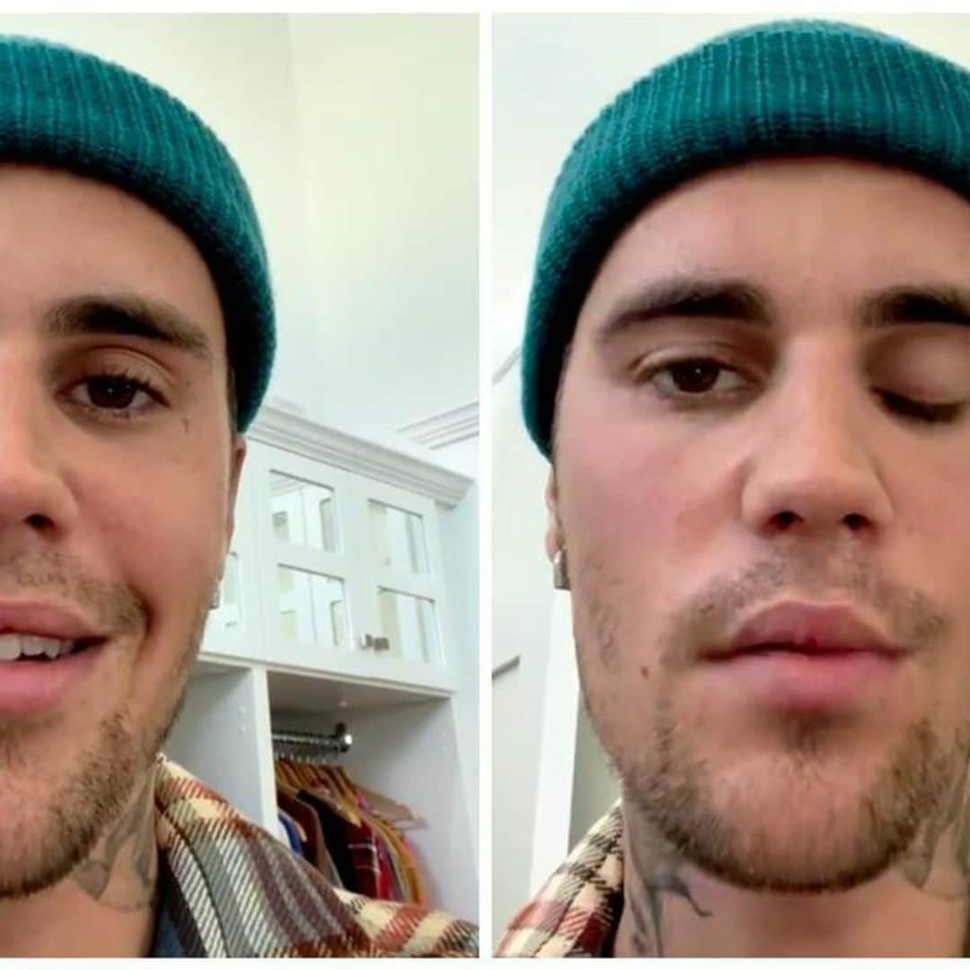 Justin Bieber has been diagnosed with Ramsay Hunt Syndrome; his face is partially paralyzed