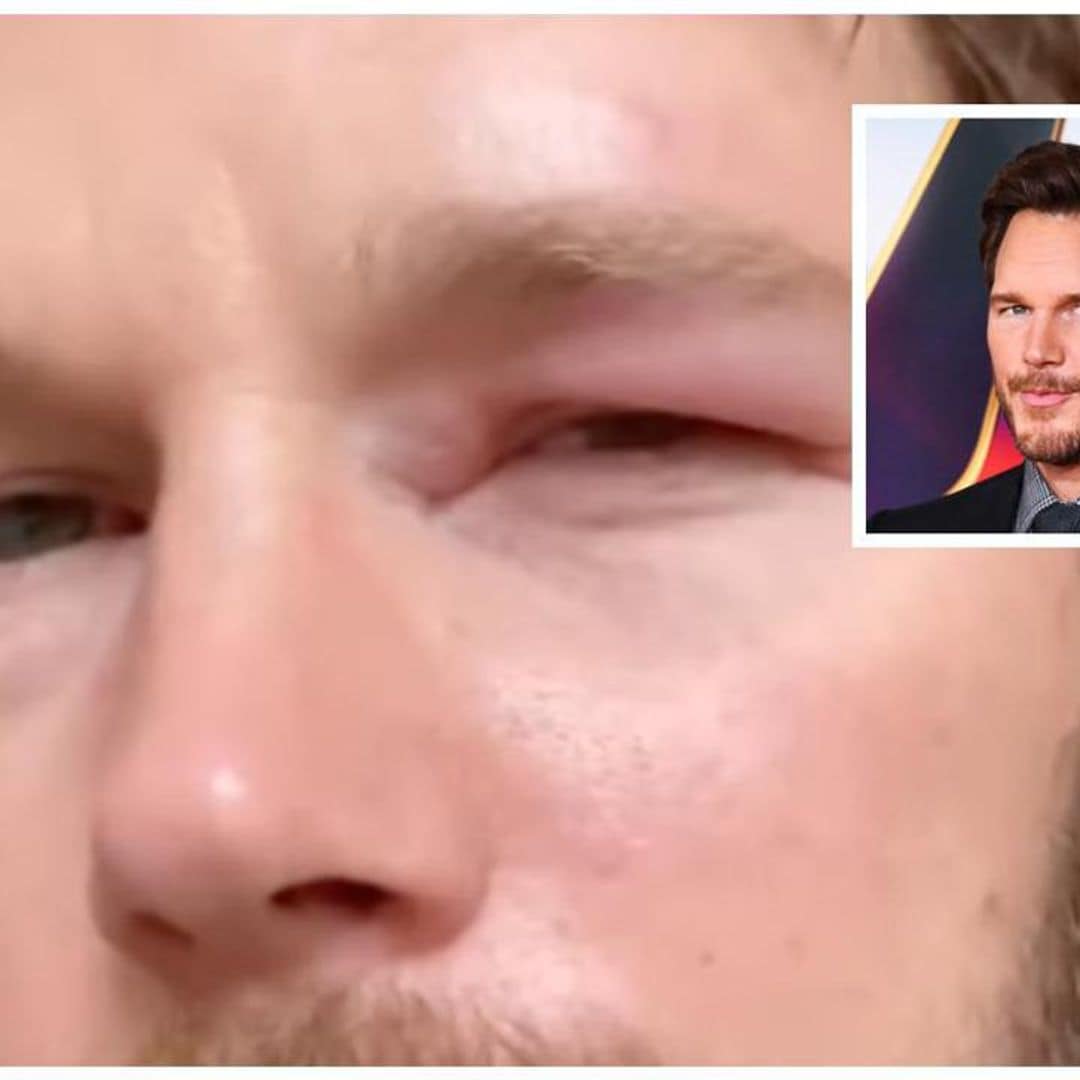 Chris Pratt will spend Christmas with a swollen eye after approaching a beehive