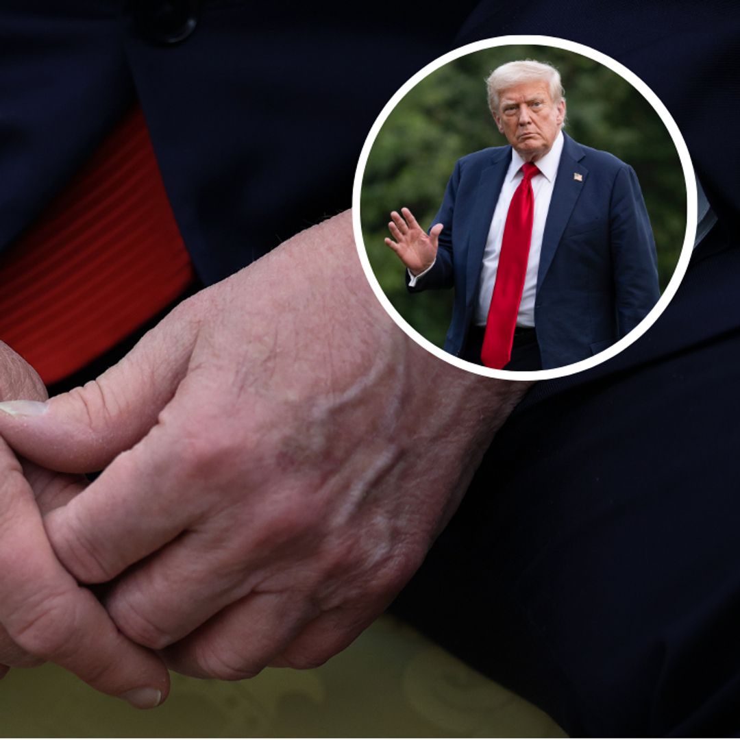 Trump's chronic vein condition explained: What is chronic venous insufficiency?