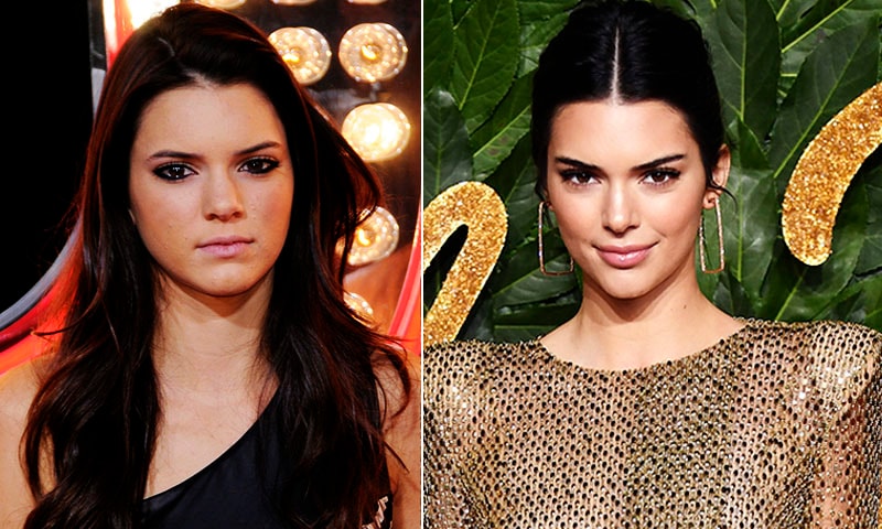 kendall-jenner-acne-antes-despues
