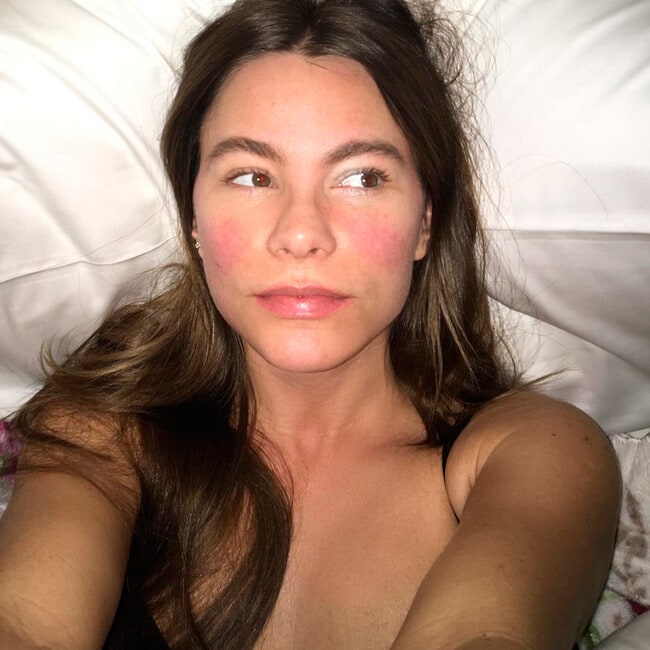 Sofia Vergara reveals that the lights on set have caused this skin disease