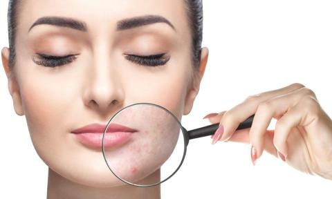 El maquillaje permite disimular el problema del acné